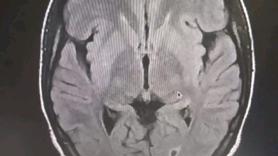 صورة المستشفى العسكري يشهد عملية تفتيت جلطة دماغية تجرى لأول مرة في المستشفيات الوطنية